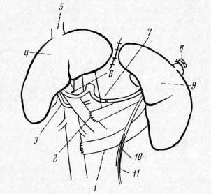 Трансплантация печени на место удаленной селезенки