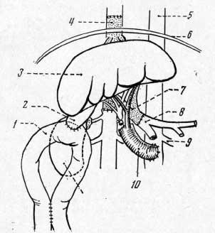 Ортотопическая аллотрансплантация печени у собак (Starzl et al., 1964)
