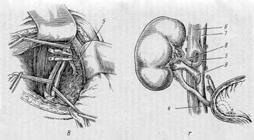 Этапы трансплантации почки в таз у человека (Calne, 1963) (в, г)