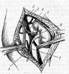 Трансплантация почки на бедро
