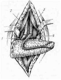 Аутотрансплантация хвоста поджелудочной железы