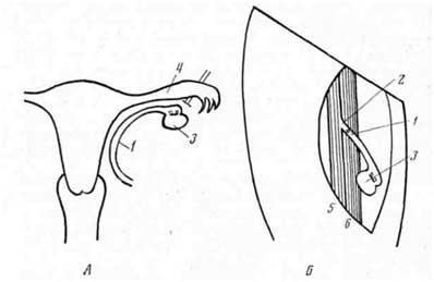 Аллотрансплантация яичника на бедро у человека (И. Д. Андреев, 1969)