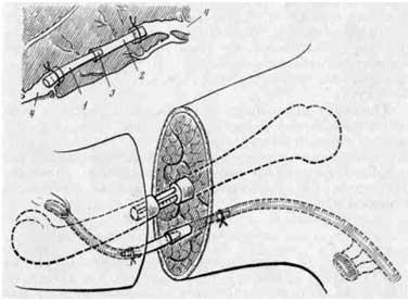 Техника протезирования лимфатических сосудов конечности (И. Д. Кирпатовский, 1968)