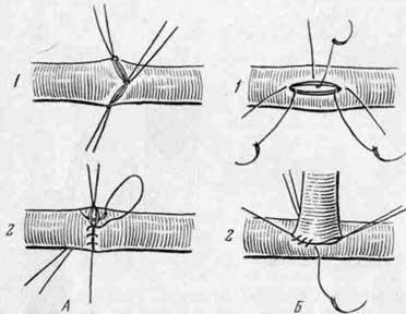 Техника наложения сосудистого шва по Carrel