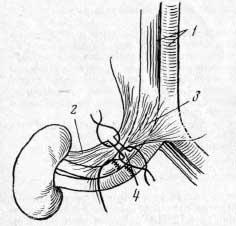Техника хирургической реиннервации трансплантата висцерального органа (И. Д. Кирпатовский, 1968)