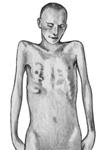 Западение грудины вследствие разъединения хрящевидных и костных частей ребер.