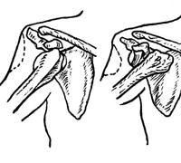 Виды передних вывихов плеча.