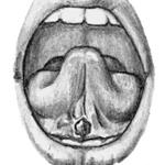Коклюш. Язвочка на уздечке языка.