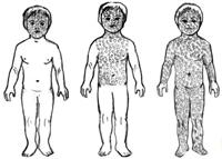 Схема этапности коревого высыпания у детей 