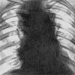 Лимфогранулематоз. Рентгенологическая картина при поражении лимфатических узлов средостения и корней легких.