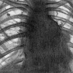 Лимфогранулематоз. Рентгенологическая картина при поражении лимфатических узловсредостения и корней легких.