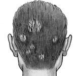 Поверхностная трихофития волосистой части головы.