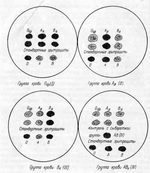 Определение групп крови системы АВ0 перекрестным способом (возможные результаты перекрестного метода)