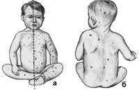 Ветряная оспа: а - типичная форма, б - атипичная форма.