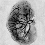 Артериограмма пиелонефритической почки.В верхнем и нижнем полюсе почки картина"обгорелого дерева".