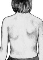 Поражения мышц плечевого пояса слева.