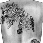 Клиническая картина (третичный сифилис: бугорковые и узловые сифилиды)