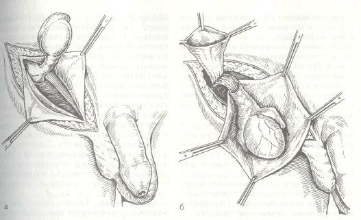 Мобилизация семенного канатика и яичка