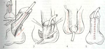 Схема пластики мочеиспускательного канала
