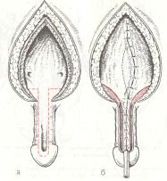 Пластика шейки мочевого пузыря и уретры по Юнгу — Диссу при полной эписпадии