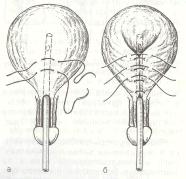 Пластика  шейки мочевого пузыря при полной эписпадии по Державину