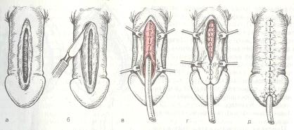 Этапы пластики уретры