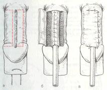 Пластика уретры при  эписпадии