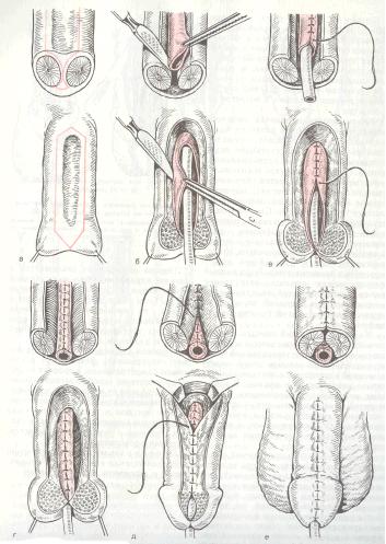 Этапы пластики уретры при эпнспадии по Юнгу