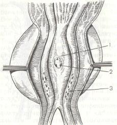 Задняя  стенка  предстательного отдела мочеиспускательного канала