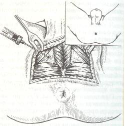 Линия разреза и положение иглы при оперативном лечении