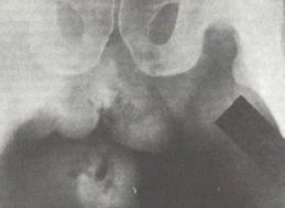 Обзорная рентгенограмма таза и мошонки