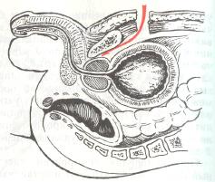 Позади лобковая аденомэктомия по Лидскому