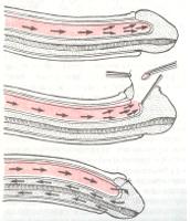 Приапизм (Создание шунта между пещеристым и губчатым телами)