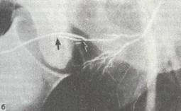 Облитерация глубокой артерии полового члена