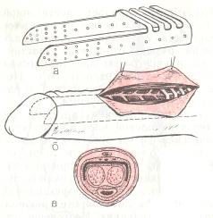 Имплантирование протезов полового члена (II)