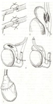 Все способы хирургического восстановления проходимости семявыносящего протока