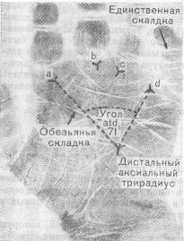 Отпечаток ладони ребенка с синдромом Дауна