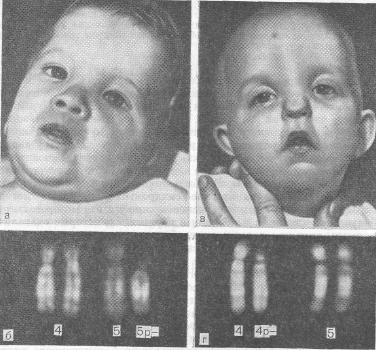Больные с частичной делецией короткого плеча хромосом группы В