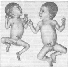 Однояйцовыь близнецы с незначительной степенью недоношешгости