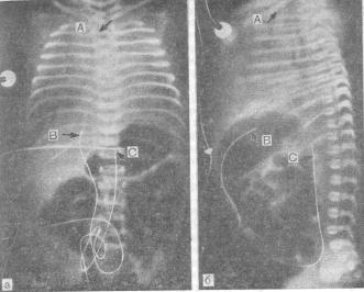 Рентгенограмма новорожденного с болезпыо гиалиновых мембран