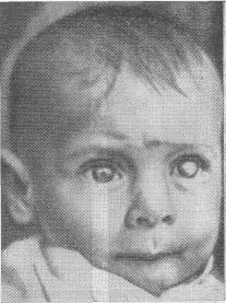 Ребенок после заболевания ксерофтальмией