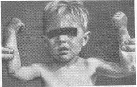 Пеллагра у мальчика в возрасте 3 лет