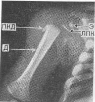 «Смещенные диафизы» при цинге