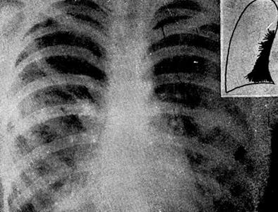 Хронические пневмонии (Рентгенография)