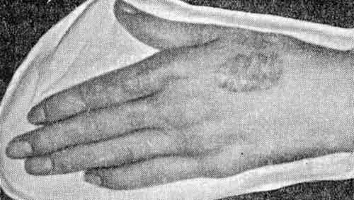 Волчаночная эритема на кистях рук