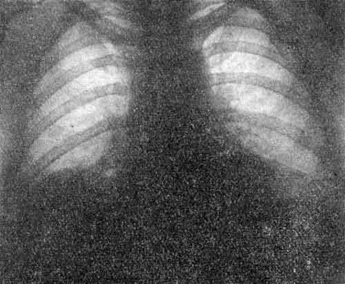 Органы дыхания (рентгенологические данные)