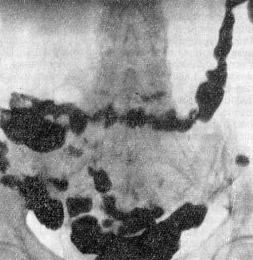 Органы пищеварения и брюшной полости (рентгеноскопическая картина)