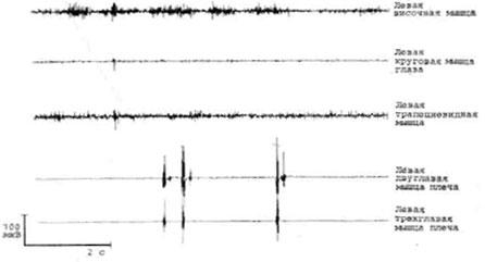 ЭМГ запись при отведении поверхностными электродами у больного 22 лет с простыми тиками в левой руке