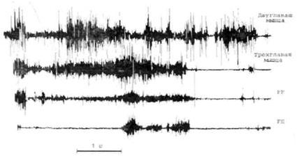Одновременные длительные разряды мышечной активности в мышцахантагонистах на ЭМГ
