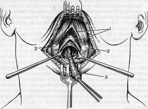 Удаление срединного свища шеи